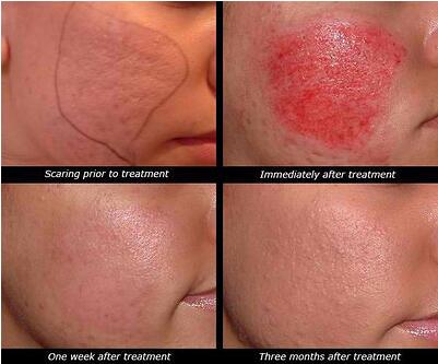 Derma roller