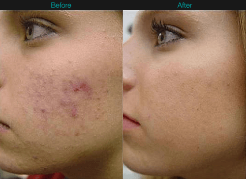 Micro needling skin treatment results